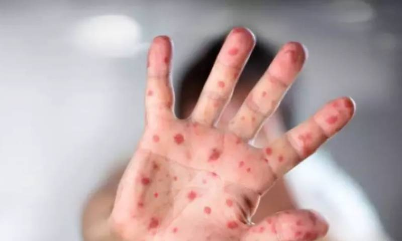 Casos de sarampo em outros Estados reforçam alerta no Rio Grande do Sul
